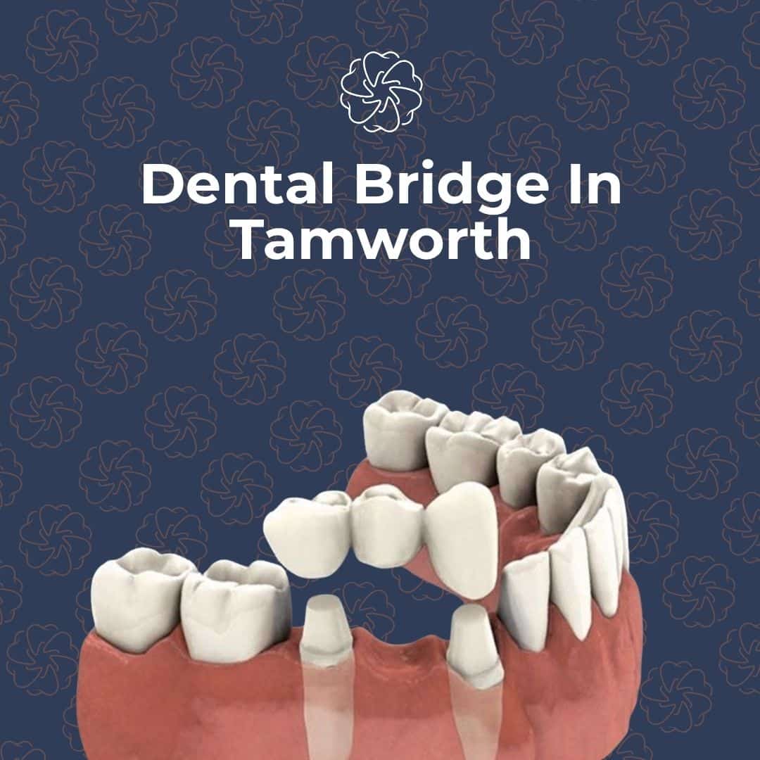 Dental bridge In Tamworth