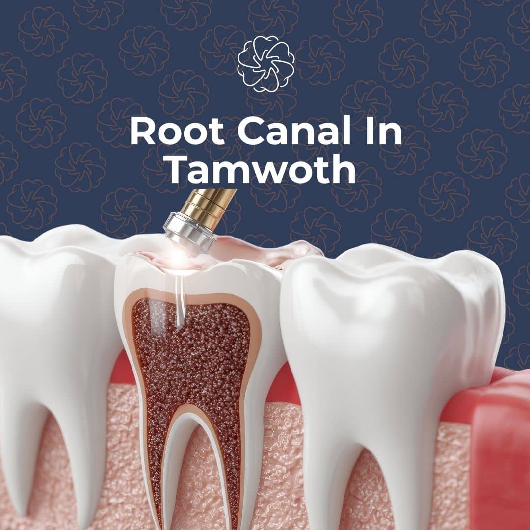 root canal In Tamworth