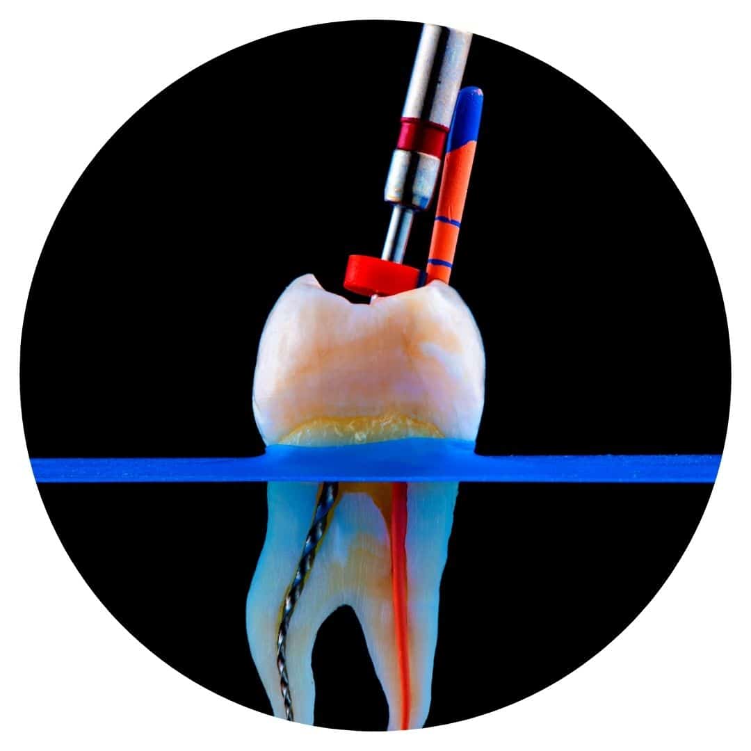root canal In Tamworth