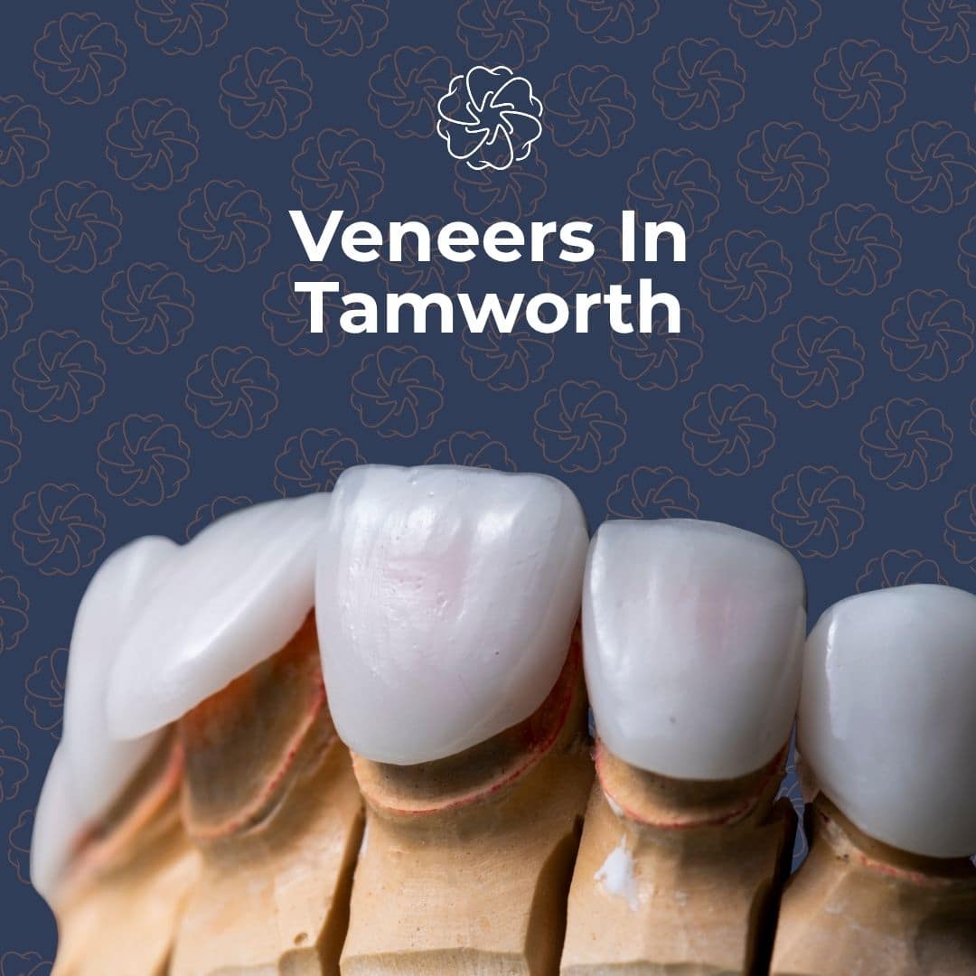 Veneers in tamworth