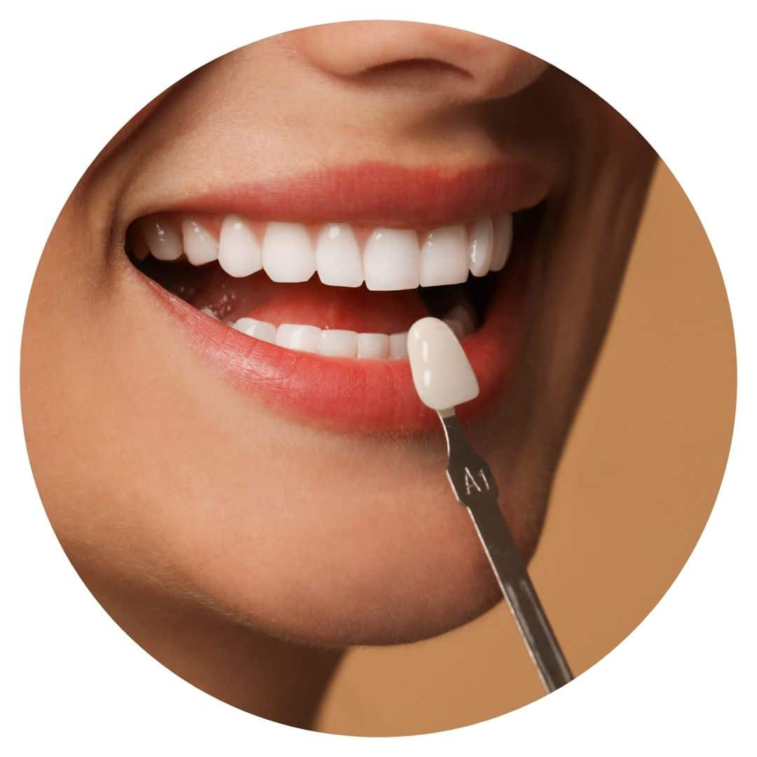 Veneers in tamworth