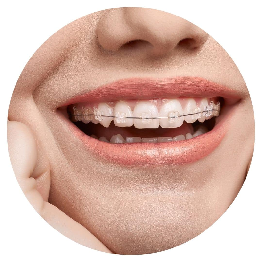 Close-up smile showing clear ceramic dental braces on teeth