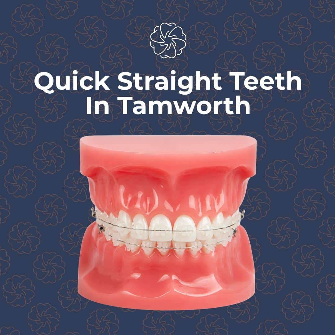 Dental model with braces promoting Quick Straight Teeth Tamworth