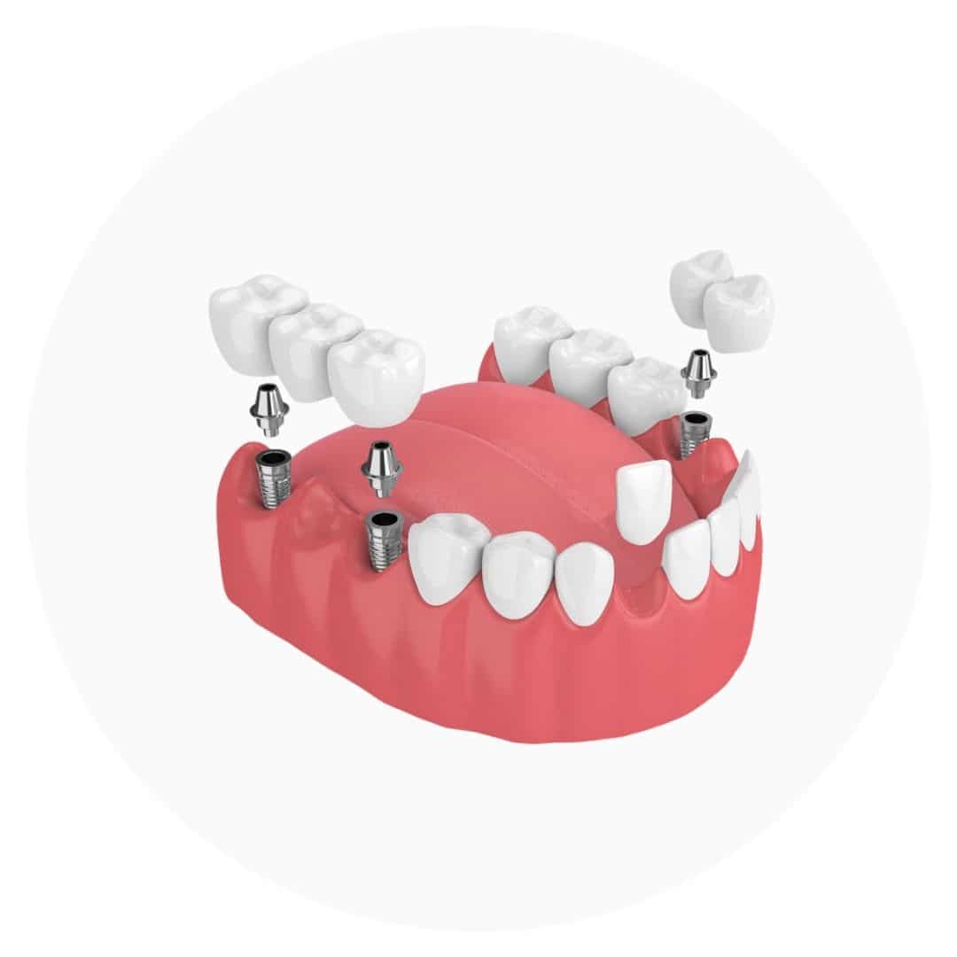 3D dental implant model showing crowns and abutments