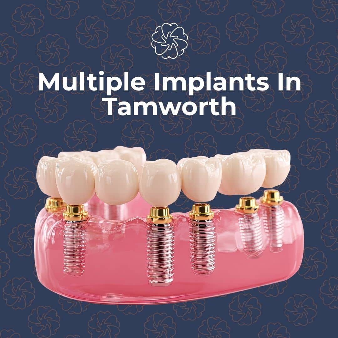 3D model of multiple dental implants with crowns