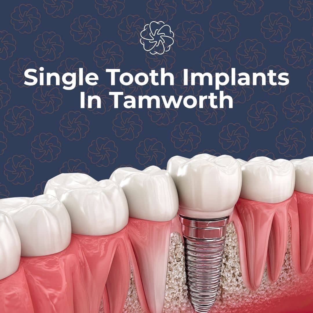 Dental Implants In Tamworth