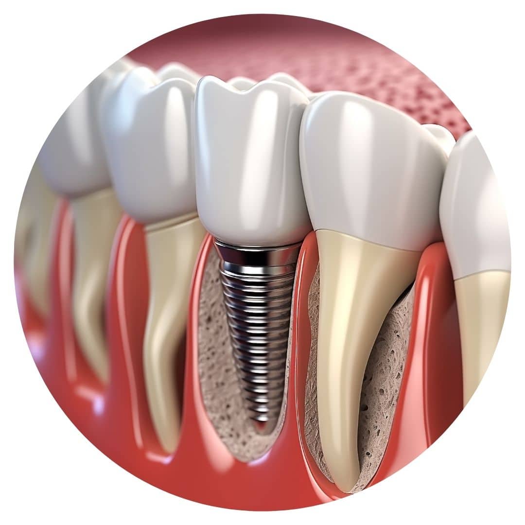 3D cross-section illustration of a dental implant in jawbone