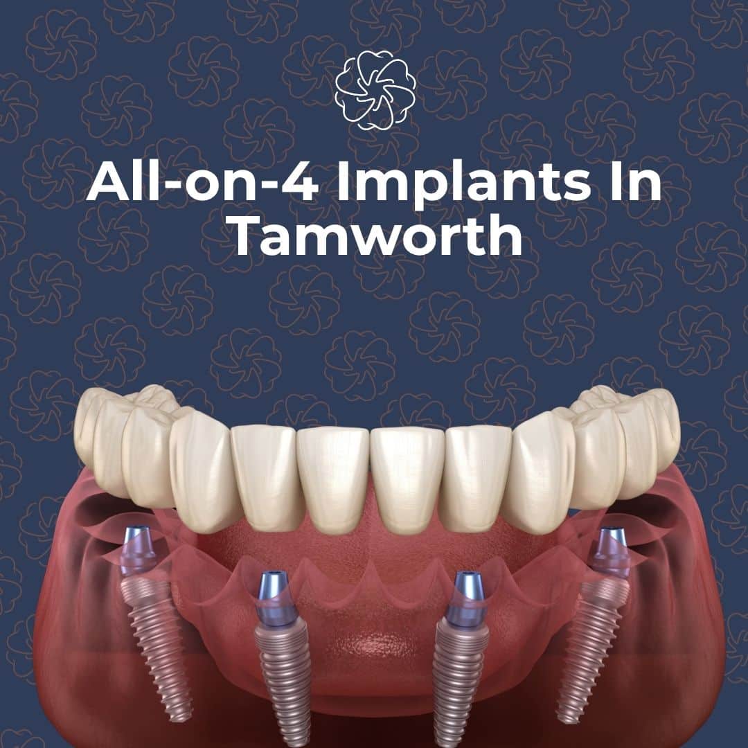Dental Implants In Tamworth