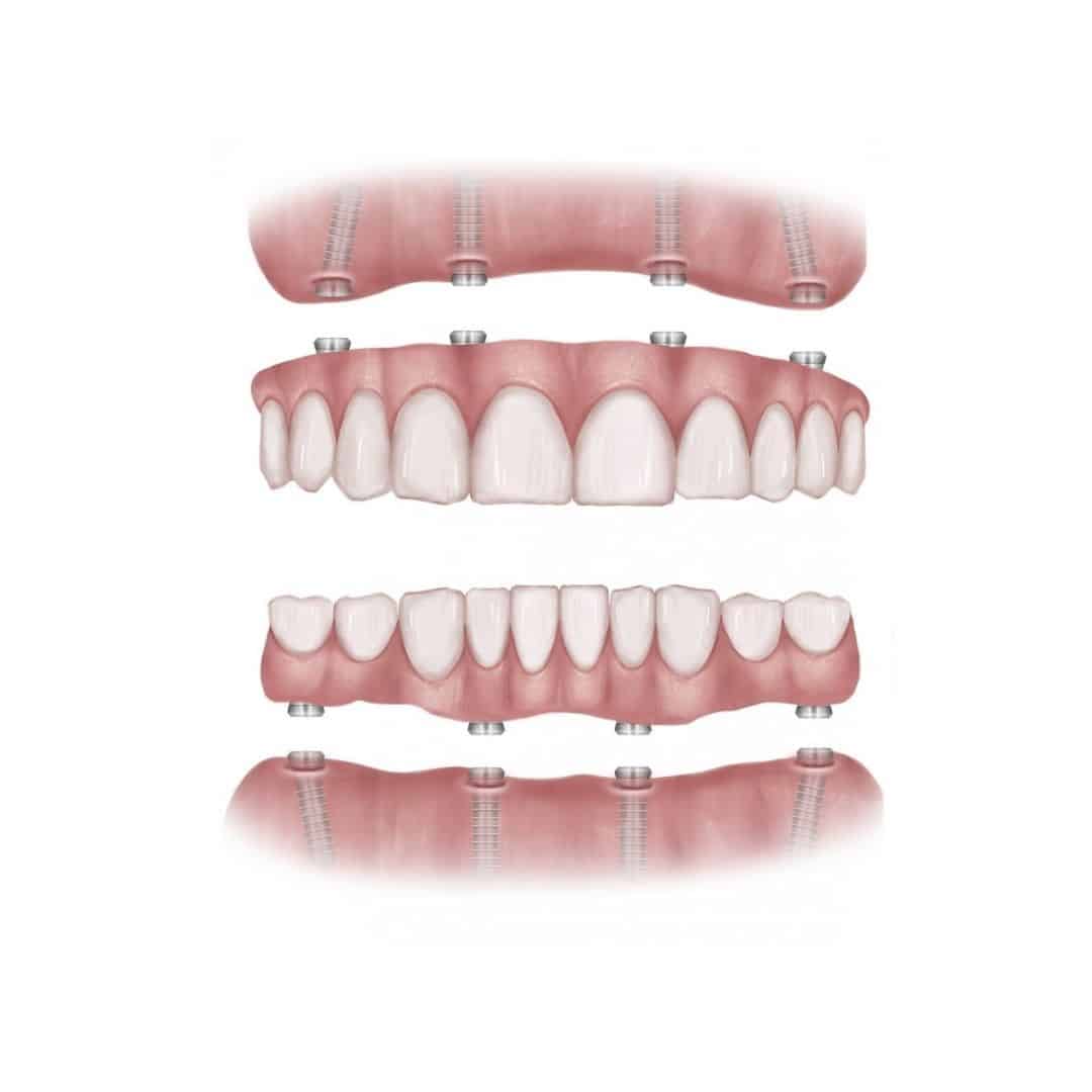 Dental Implants In Tamworth