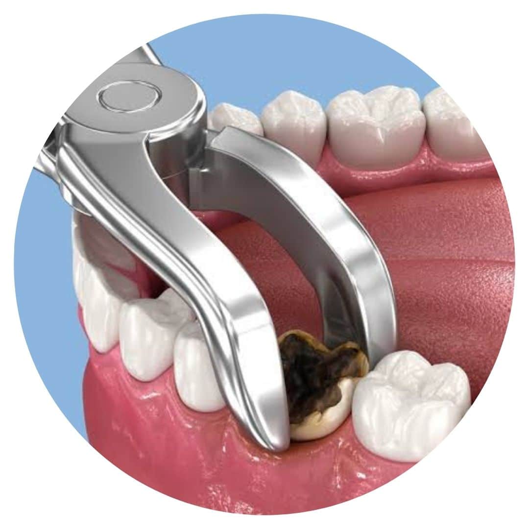 Tooth extractions in Tamworth