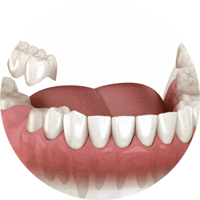 dental bridge